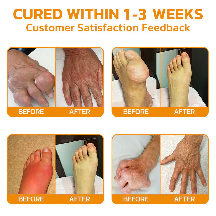 ✅ Official Store: SEURICO™ Bee Venom Joint Repair Cream 👨⚕️ American Orthopaedic Association (AOA) Approved (Reduces joint swelling, pain, stiffness, redness, warmth, soreness, and joint fatigue).