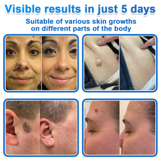 🎁2-in-1 Microneedle & Hydrocolloid Patch | Raised Moles,Acne, Flat Warts & Skin Tags Remover | Improves Wrinkles, Scars & Blemishes🎁