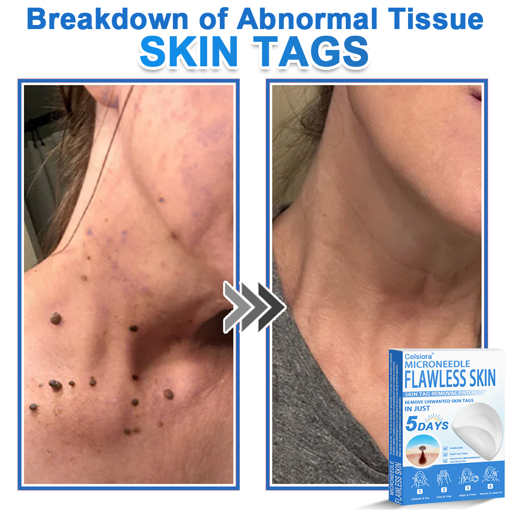 🎁2-in-1 Microneedle & Hydrocolloid Patch | Raised Moles,Acne, Flat Warts & Skin Tags Remover | Improves Wrinkles, Scars & Blemishes🎁