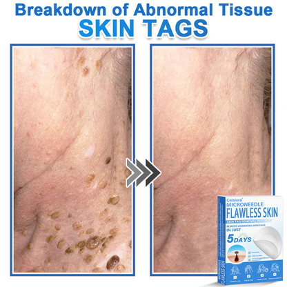 🎁2-in-1 Microneedle & Hydrocolloid Patch | Raised Moles,Acne, Flat Warts & Skin Tags Remover | Improves Wrinkles, Scars & Blemishes🎁