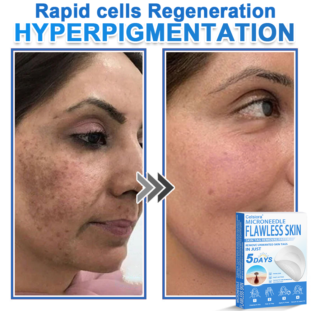 🎁2-in-1 Microneedle & Hydrocolloid Patch | Raised Moles,Acne, Flat Warts & Skin Tags Remover | Improves Wrinkles, Scars & Blemishes🎁