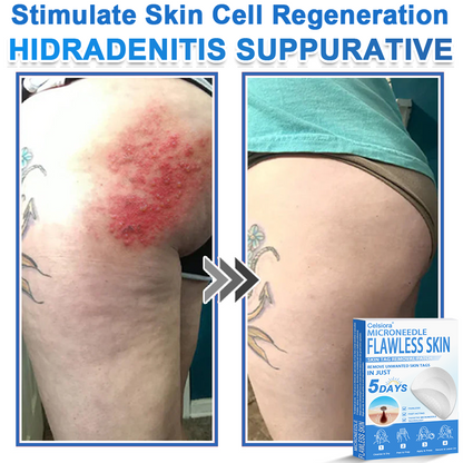 🎁2-in-1 Microneedle & Hydrocolloid Patch | Raised Moles,Acne, Flat Warts & Skin Tags Remover | Improves Wrinkles, Scars & Blemishes🎁