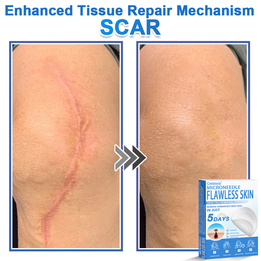 🎁2-in-1 Microneedle & Hydrocolloid Patch | Raised Moles,Acne, Flat Warts & Skin Tags Remover | Improves Wrinkles, Scars & Blemishes🎁