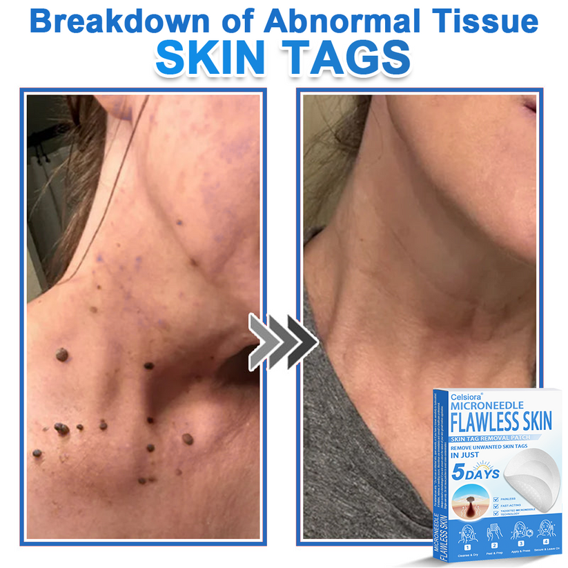 🎁2-in-1 Microneedle & Hydrocolloid Patch | Raised Moles,Acne, Flat Warts & Skin Tags Remover | Improves Wrinkles, Scars & Blemishes🎁