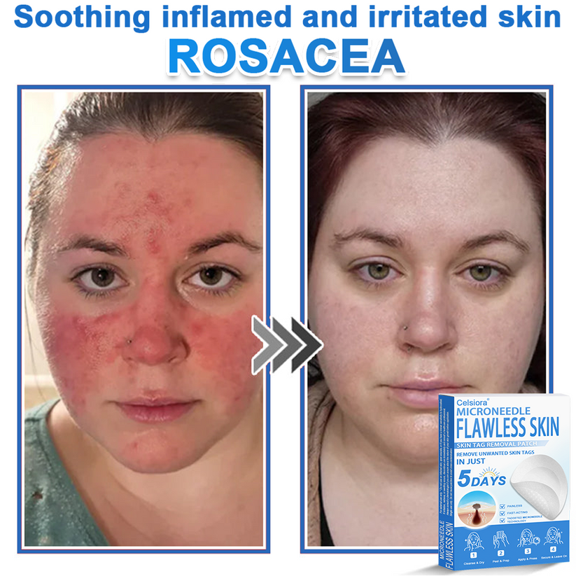 🎁2-in-1 Microneedle & Hydrocolloid Patch | Raised Moles,Acne, Flat Warts & Skin Tags Remover | Improves Wrinkles, Scars & Blemishes🎁