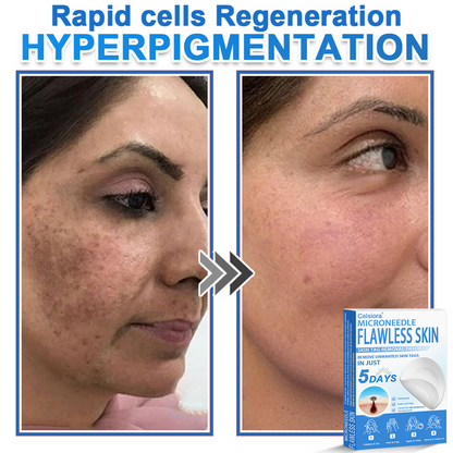 🎁2-in-1 Microneedle & Hydrocolloid Patch | Raised Moles,Acne, Flat Warts & Skin Tags Remover | Improves Wrinkles, Scars & Blemishes🎁