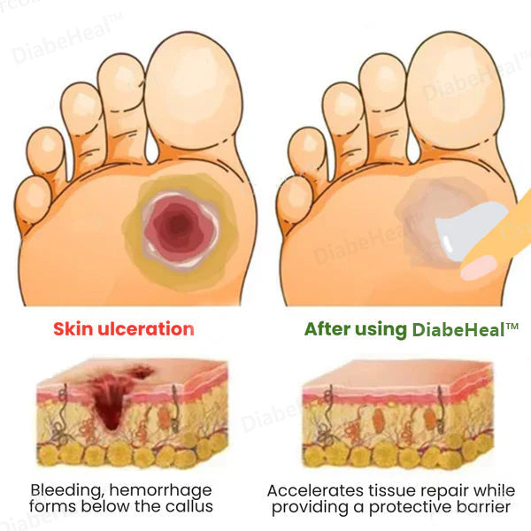 🌿DiabeHeal™ Diabetic Skin Healing Cream🌿