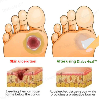 🌿DiabeHeal™ Diabetic Skin Healing Cream🌿