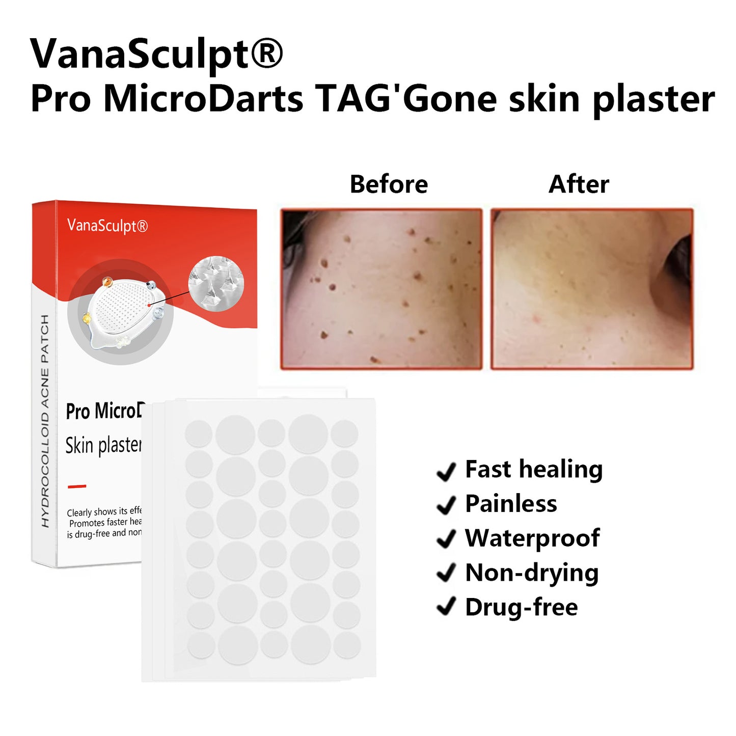 VanaSculpt® Pro MicroDarts TAG'Gone skin plaster for the removal of skin tags