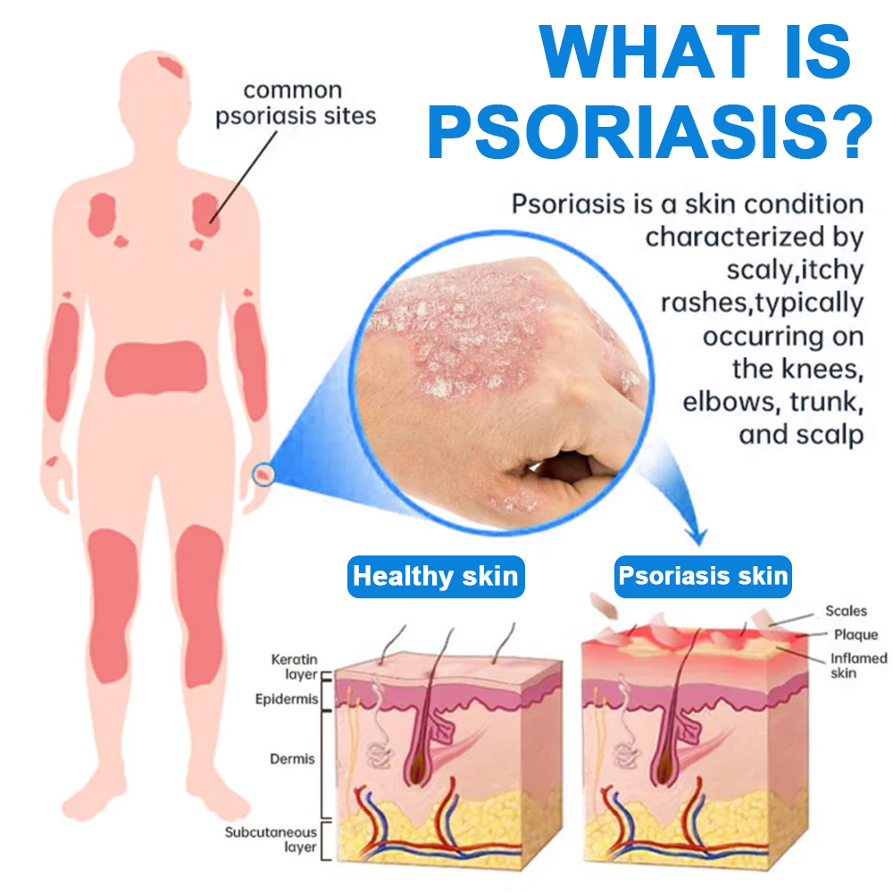 ✅  Official Store: Cvreoz® Magnesium Herbal Psoriasis Spray ⚕️