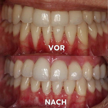 ✅ Seurico™ Gum Repair & Oral Health Powder (CE-certified for Periodontitis, Mouth Ulcers, and Gum Recession)