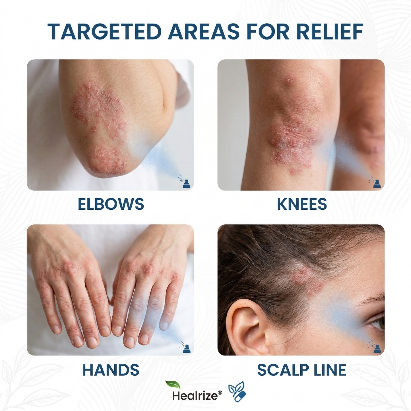 🔥Magnesium Botanical Spray – Advanced Skin Recovery for Psoriasis & Eczema | Rapid Soothing, Steroid-Free