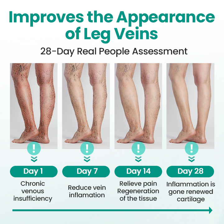 ✅Naturbelassen® Leg Renew Patch (For Varicose Veins, Spider Veins, Swelling & Leg Fatigue)✅