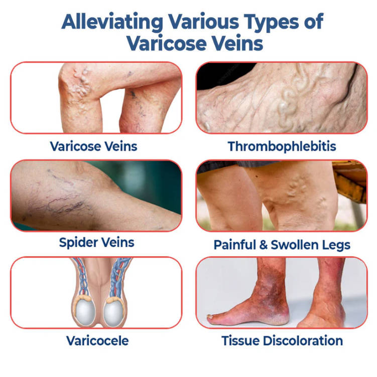 SEURICO™ Vein Dredge Silkworm Extract Spray 🌿✨ - Relief for Varicose Veins & Better Circulation 💪💧