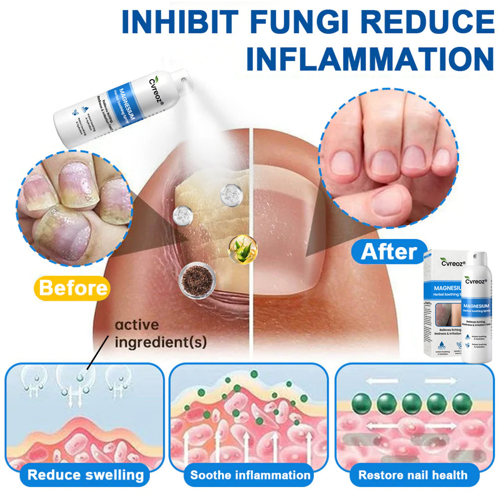 ✅  Official Store: Cvreoz® Magnesium Herbal Psoriasis Spray ⚕️