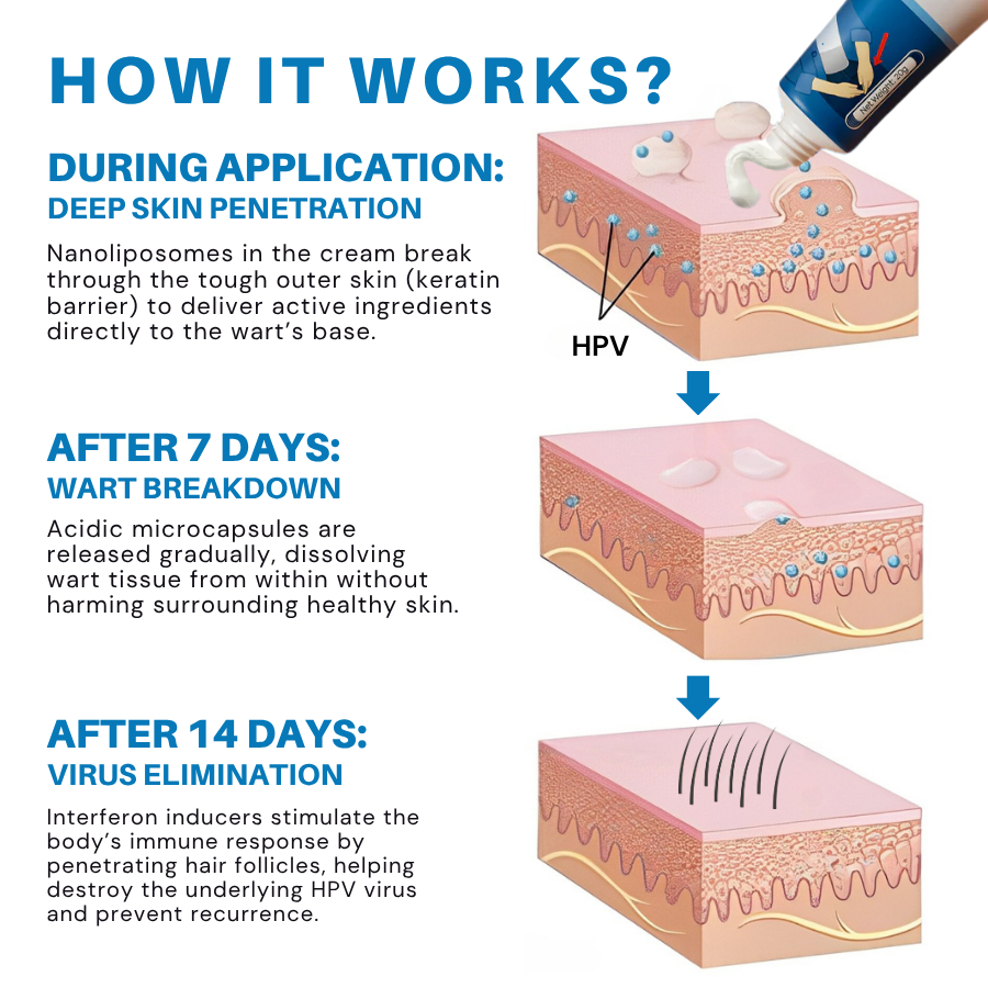 Vironexil® Clinical HPV Wart Therapy Cream for Men (Advanced Nanoliposome Delivery + Immune Activation for Root-Level HPV Wart Elimination)