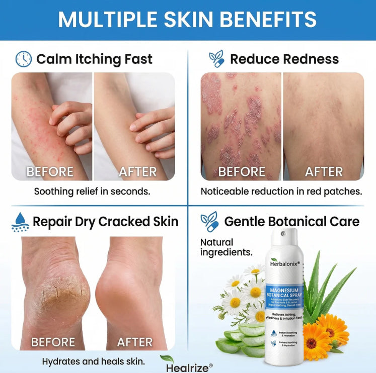 🔥Magnesium Botanical Spray – Advanced Skin Recovery for Psoriasis & Eczema | Rapid Soothing, Steroid-Free