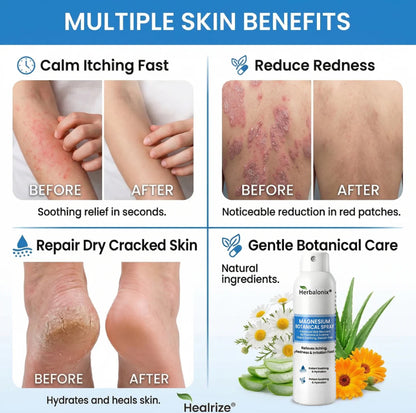 🔥Magnesium Botanical Spray – Advanced Skin Recovery for Psoriasis & Eczema | Rapid Soothing, Steroid-Free
