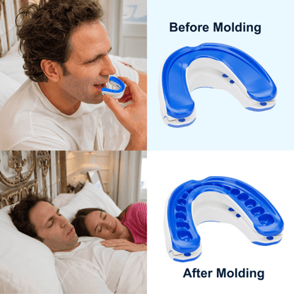 SEURICO™ Stop Snoring Device